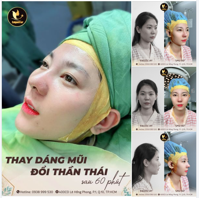 THAY DÁNG MŨI - ĐỔI THẦN THÁI CHỈ SAU 60 PHÚT