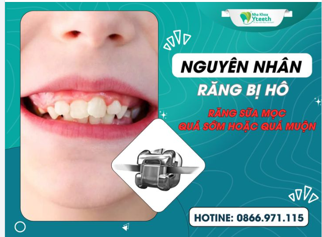 Nguyên nhân răng bị hô - Răng sữa mọc quá sớm hoặc quá muộn