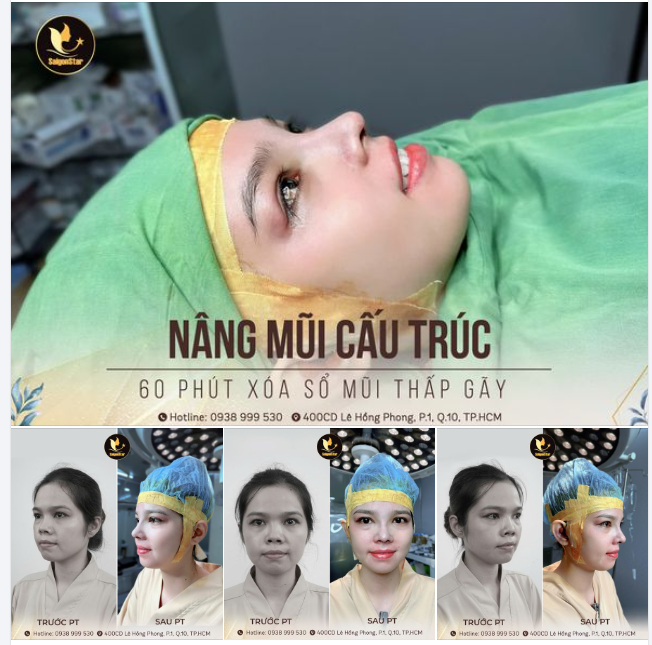 TÁI CẤU TRÚC TOÀN BỘ DÁNG MŨI - XÓA SỔ MŨI THẤP GẪY