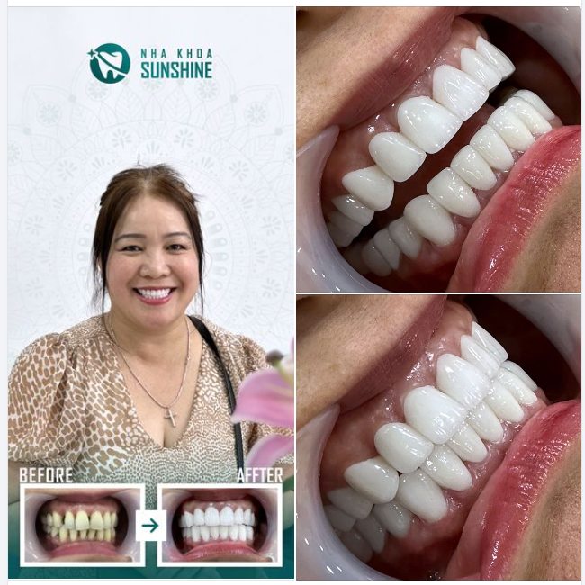Với tình trạng răng Ố VÀNG, KHÔNG ĐỀU MÀU VÀ HÌNH THỂ RĂNG THƯA, chị Hương Hoàng đã không còn tự tin với bản thân mỗi khi giao tiếp trong thời gian dài.
