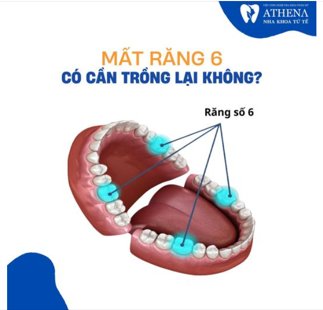 Bạn bắt buộc phải trồng lại răng số 6 bởi các lý do dưới đây