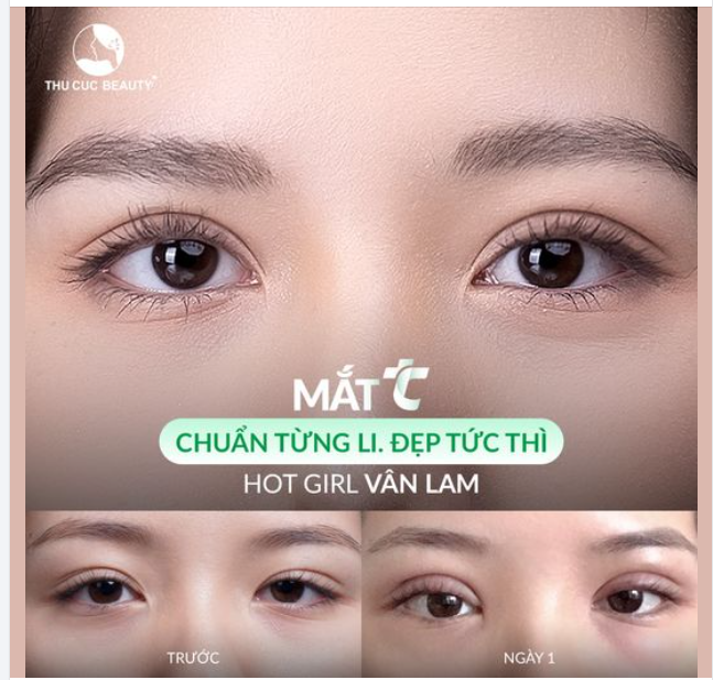 Sụp mí, mắt lờ đờ 15P  Mí rõ nét, cân đều đẹp sang chảnh