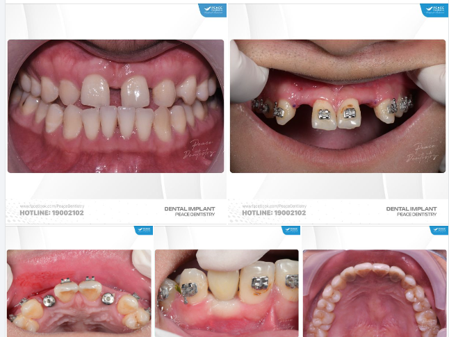 CA ĐIỀU TRỊ LIÊN CHUYÊN KHOA IMPLANT CHỈNH NHA