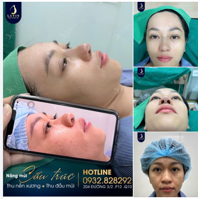 BIẾN HÌNH DÁNG MŨI MỚI CHO CHỊ KHÁCH HÀNG ĐẾN TỪ ĐỒNG THÁP