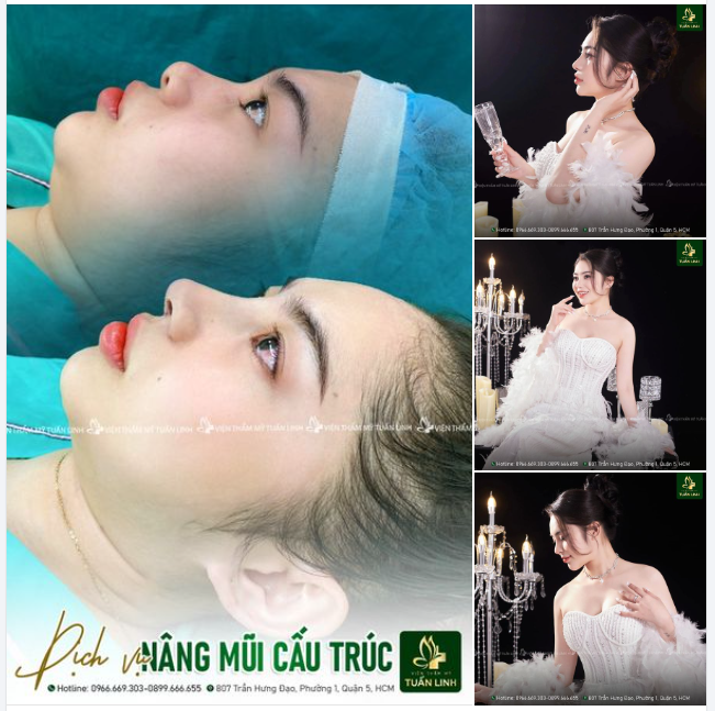 Trẻ trung, xinh đẹp, sắc nét hơn nhờ chiếc mũi cao thanh tú!!