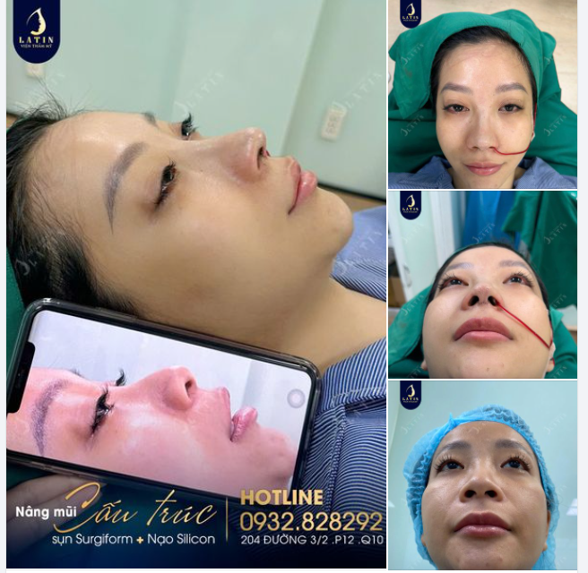 Biến chứng mũi vì trước đó tiêm filler có chứa sillicon