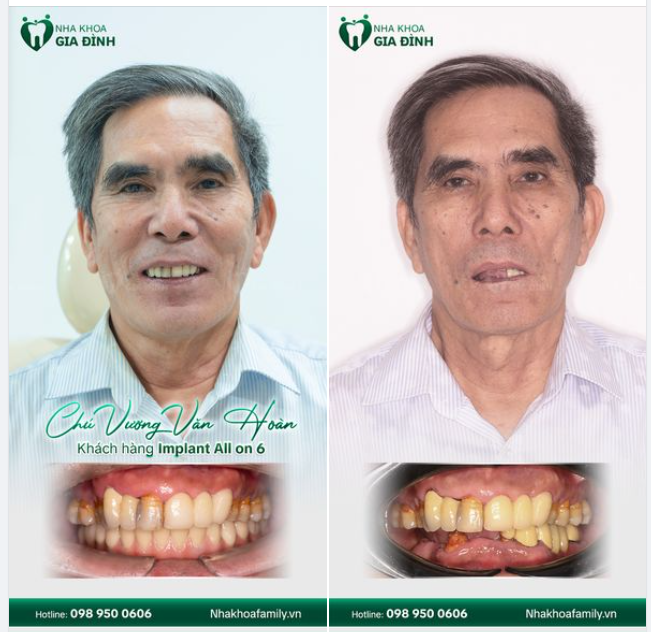 TRỒNG RĂNG IMPLANT ALL ON 6 - AN TOÀN, ĂN NHAI NHƯ RĂNG THẬT