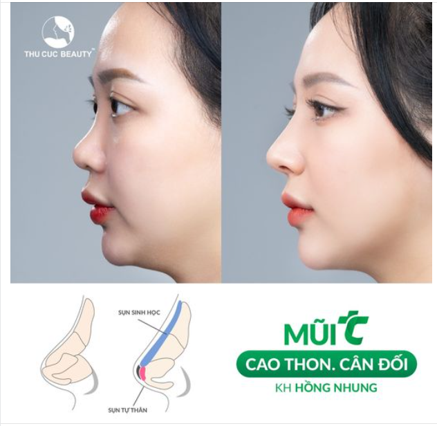 Nâng mũi bằng sụn tự thân cao, thon cân đối