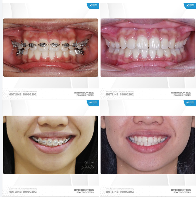 CA NIỀNG RĂNG CHỈNH HÔ & ĐÁNH LÚN CHỮA CƯỜI HỞ LỢI