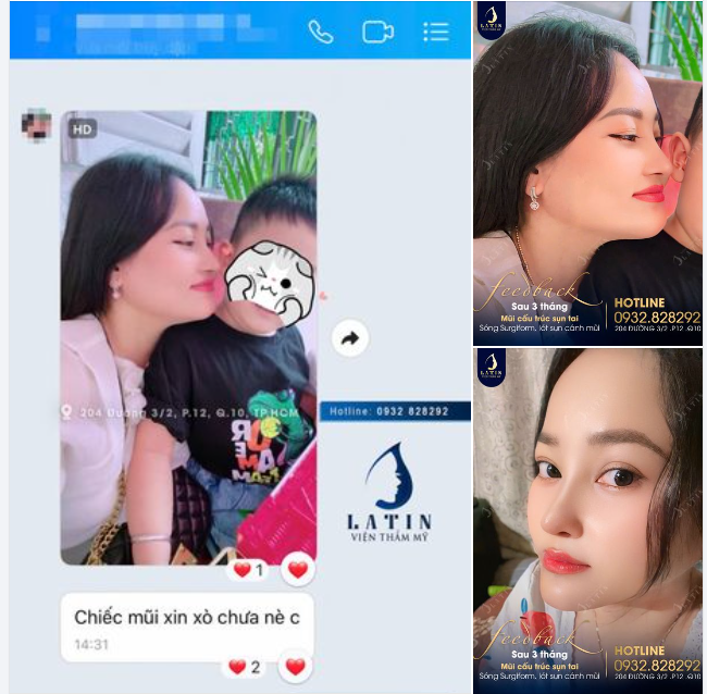 Đây chính xác là dáng mũi cao bay "thơ mộng" mà em gái luôn mong muốn.