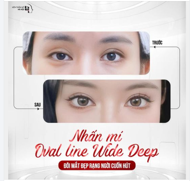 NHẤN MÍ OVAL LINE WIDE DEEP