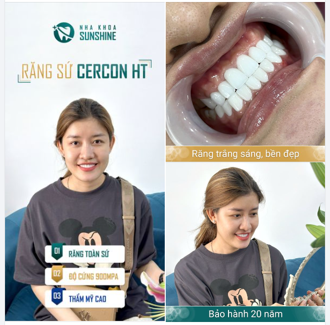 RĂNG SỨ CERCON HT CÓ PHẢI LÀ SỰ LỰA CHỌN HOÀN HẢO?