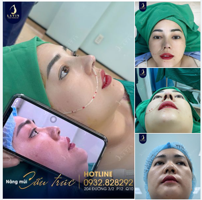 Hoàn thành ca mũi cho chị gái thích dáng cao nét