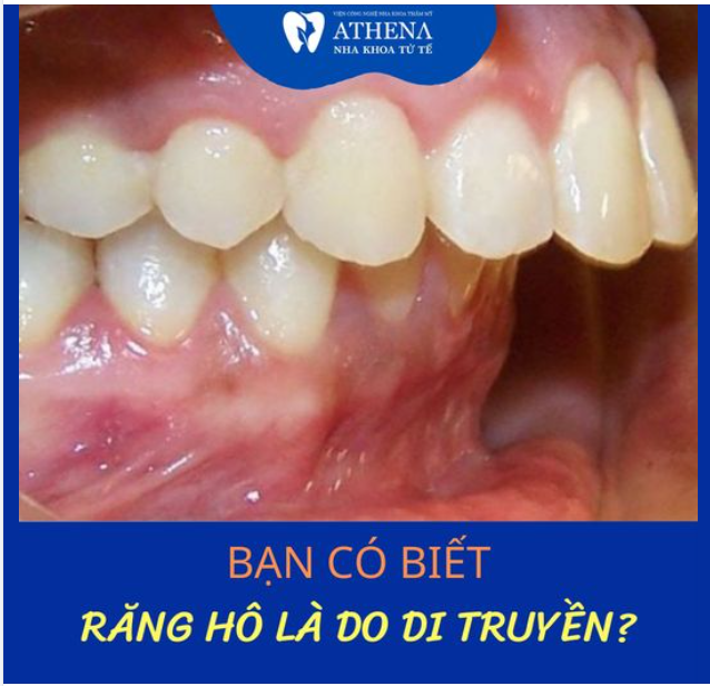 Có thể bạn chưa biết hô răng 70% là do di truyền 