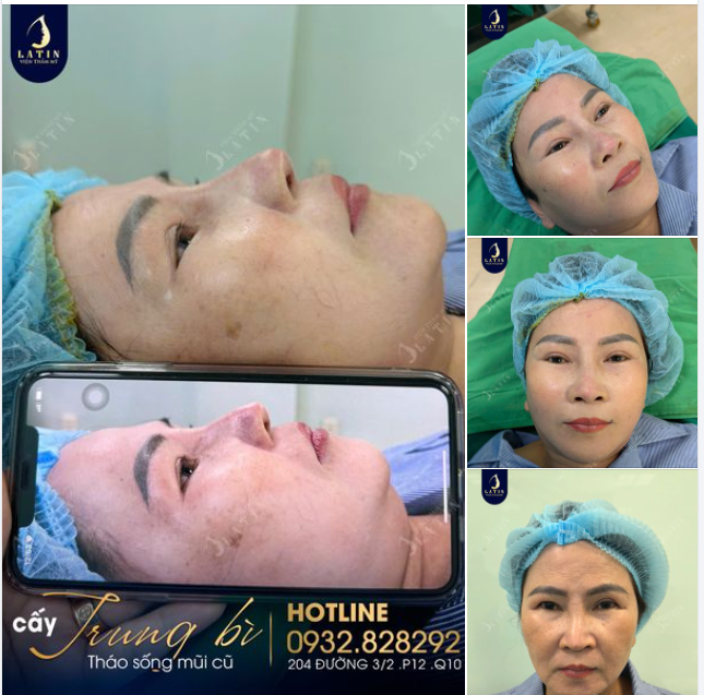 CẤY TRUNG BÌ MŨI CHO CÔ KHÁCH ĐẾN TỪ ĐỒNG NAI