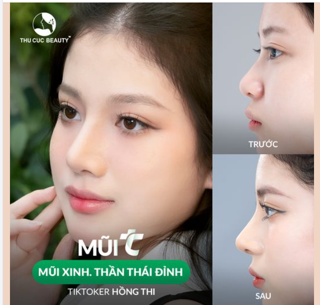 Có phải mũi tẹt thấp là nỗi lo ngại của bạn? Đừng lo đã có Thu Cúc