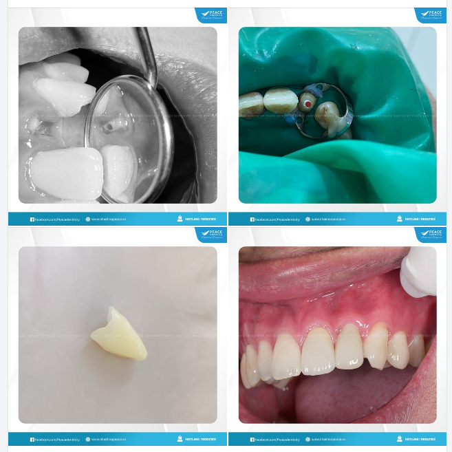 PHỤC HỒI RĂNG CHO TRƯỜNG HỢP CHỈ CÒN CHÂN RĂNG