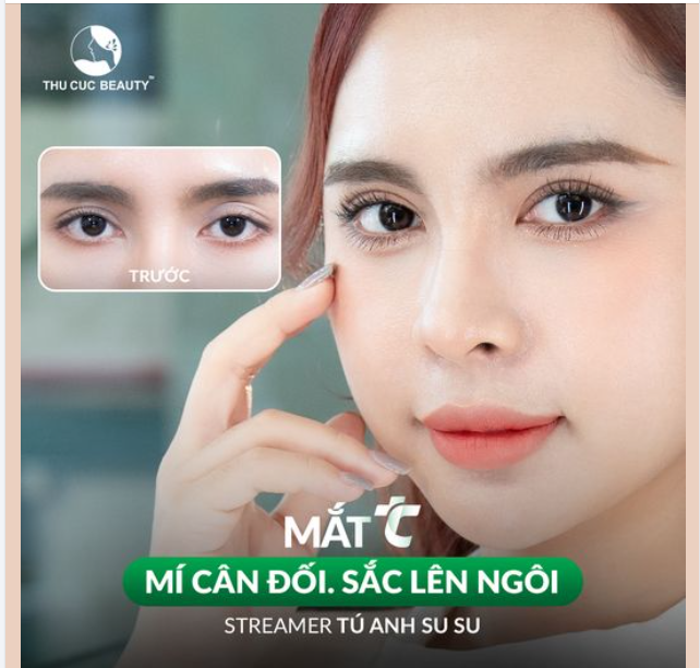 Khắc phục đa nếp mí Chọn ngay Mắt TC