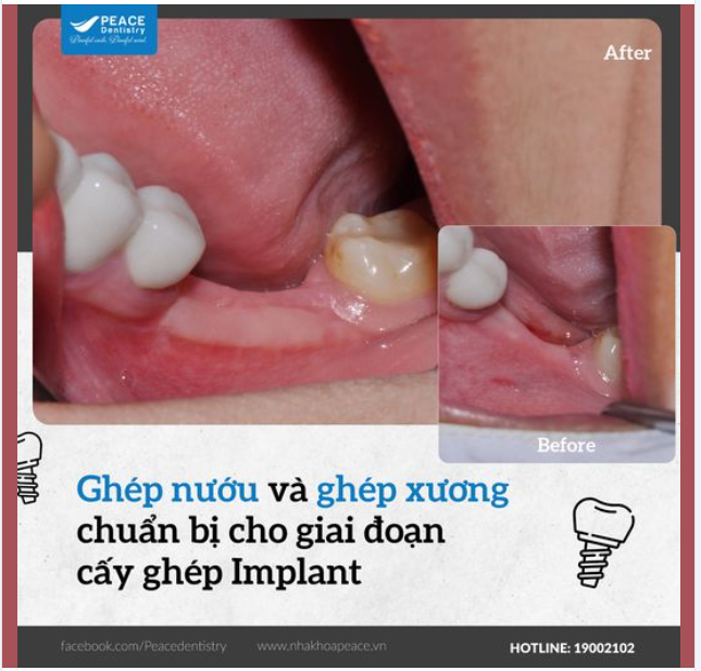 CẤY GHÉP IMPLANT VÀ CHỈ ĐỊNH GHÉP XƯƠNG, GHÉP NƯỚU