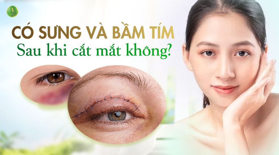 CẮT MẮT CÓ BỊ SƯNG VÀ BẦM SAU KHI THỰC HIỆN KHÔNG?