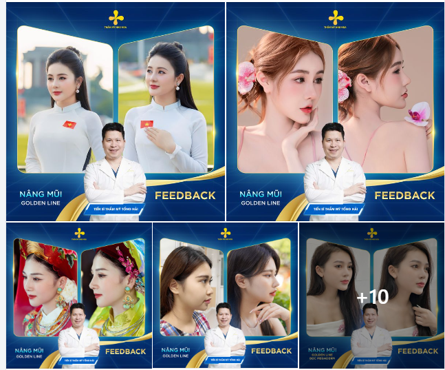 Này chị đẹp ơi! Cùng ngắm nhìn những dáng mũi của các chị đẹp nhà Như Hoa nha! Mình yêu thích dáng nào thì cùng bình luận ở bài đăng này, để Tiến sĩ thẩm mỹ Tống Hải lên kế hoạch nâng mũi cho mình nhé!