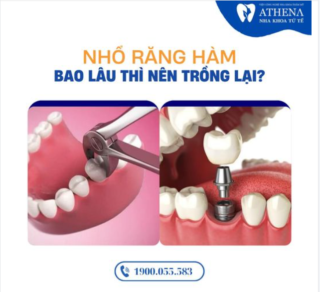 Nhổ răng bao lâu thì trồng lại?