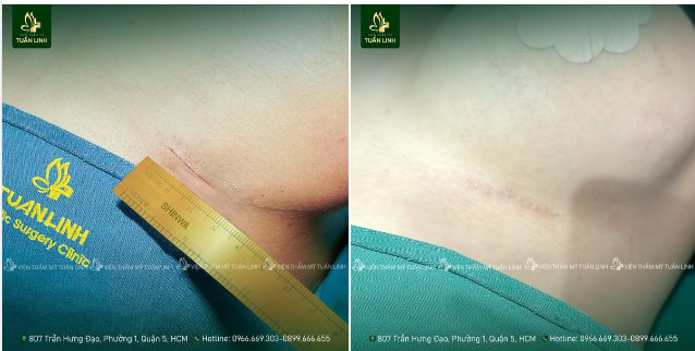 Sẹo ''tàng hình'' sau nâng cấp V1!!
