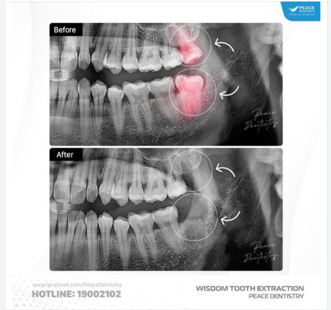 Sau đây là một số dấu hiệu cần chú ý có thể cho thấy đã đến lúc nhổ răng khôn: