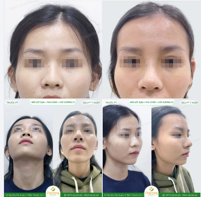 Trước khi đến với Charming, nàng khách sở hữu dáng mũi thấp với phần sóng mũi có gồ nhẹ và chóp mũi khá to, khiến tổng thể gương mặt thiếu sự thanh thoát.