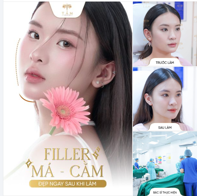 TOP DỊCH VỤ CON GÁI NÊN THỬ MỘT LẦN TOP 1: COMBO FILLER MÁ - CẰM BÍ QUYẾT TẠO NÊN VẺ ĐẸP MỀM MẠI CHỈ SAU 30 PHÚT
