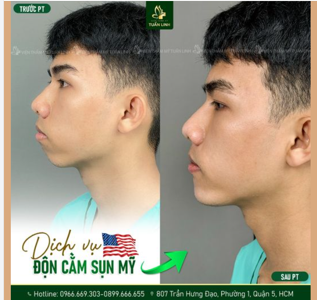 ĐỘN CẰM NAM – KHẲNG ĐỊNH PHONG ĐỘ, TẠO DÁNG V-LINE MẠNH MẼ!!