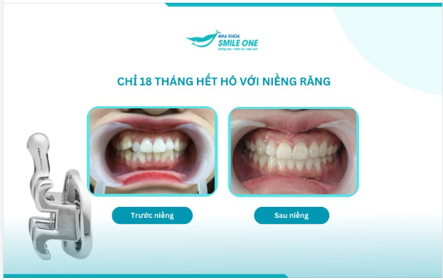 Chúc mừng Nhật Mai đã về đích xuất sắc trên hành trình niềng răng của mình.