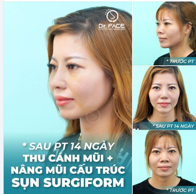 Có ai ngờ chỉ sau một ca combo nâng mũi cấu trúc sụn Surgiform + thu cánh mũi mà gương mặt bạn ấy đã thay đổi rõ rệt.