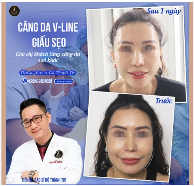 Căng Da V-Line Giấu Sẹo tại Dr Trí – Lựa chọn "vàng" cho những ai đã từng căng da mặt nơi khác bị lộ sẹo, sẹo lồi, sẹo chân rết..