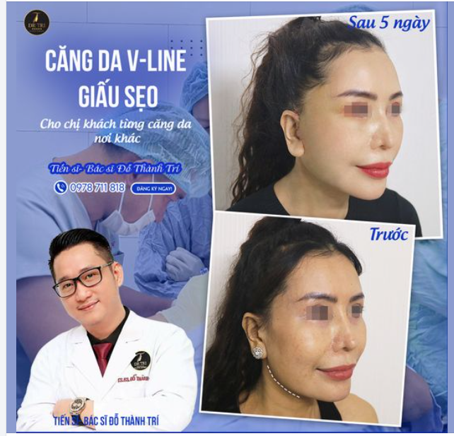 Bạn có mơ ước sở hữu một khuôn mặt V-Line thon gọn và trẻ trung như chị khách trong hình?