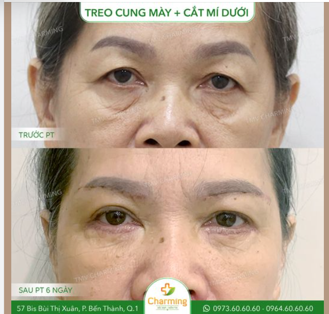 Trước khi đến với Charming, cô khách gặp tình trạng mí mắt sụp nặng và vùng da chùng nhiều ở mí dưới, khiến khuôn mặt trông mệt mỏi, già dặn.