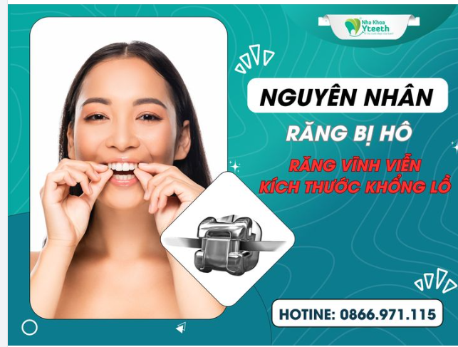 Bệnh lý về xương hàm: sự phát triển quá mức hoặc không như bình thường cũng gây ra hiện tượng răng hô.
