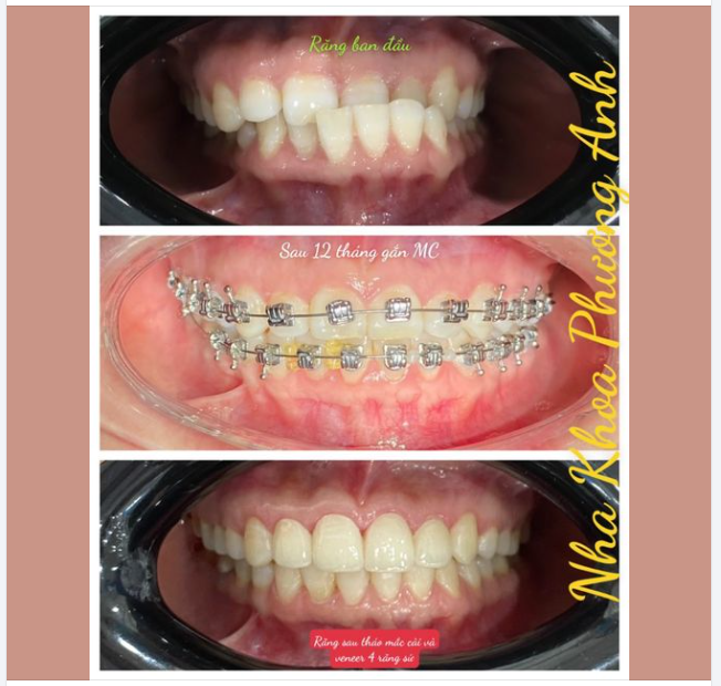 Niềng Răng Bằng Invisalign So Với Niềng Răng Truyền Thống