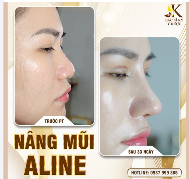 CHỊ EM NÀO MŨI THẤP, MŨI TẸT THÌ KHÔNG ĐƯỢC BỎ QUA BÀI VIẾT NÀY!!