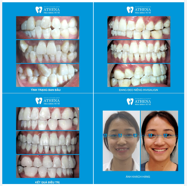 Niềng răng Invisalign có điều trị được ca khấp khểnh nặng không? câu trả lời là có!