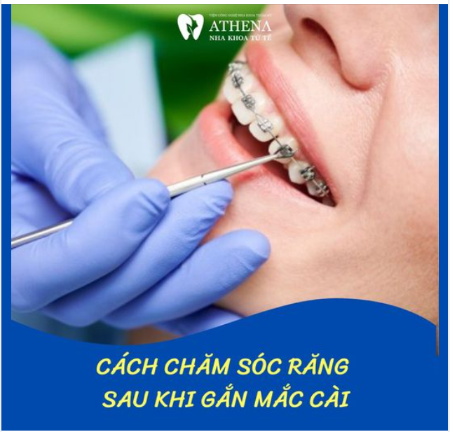 Bí kíp chăm sóc sức khỏe răng miệng Sau khi gắn mắc cài