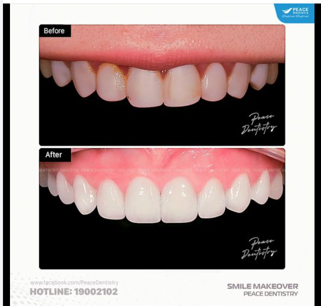 VẬT LIỆU SỨ CÓ PHẢI LÀ YẾU TỐ QUAN TRỌNG NHẤT QUYẾT ĐỊNH KẾT QUẢ THẨM MỸ?