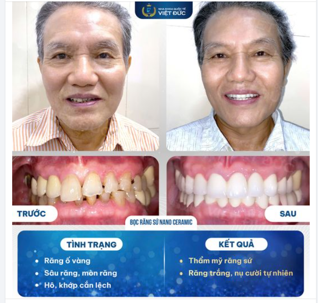 BỌC RĂNG SỨ - KHÔI PHỤC CHỨC NĂNG CỦA RĂNG