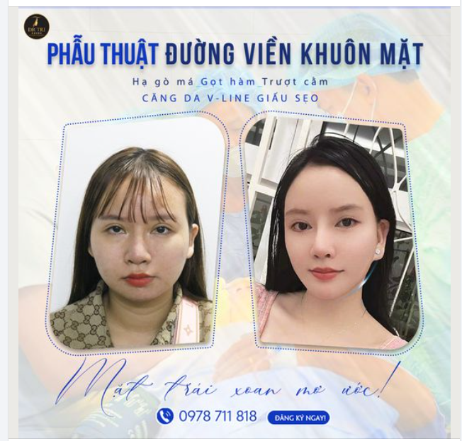Bạn Có Bao Giờ Mơ Ước Về Một Khuôn Mặt Trái Xoan Thanh Thoát?