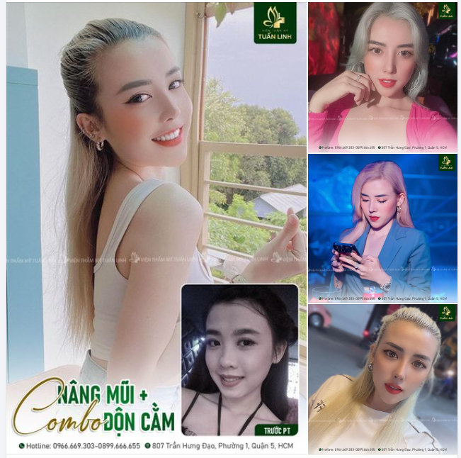 NÂNG MŨI + ĐỘN CẰM NÂNG CẤP DIỆN MẠO ĐẸP HOÀN HẢO!!