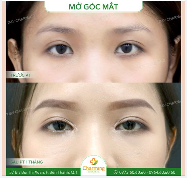 Trước khi đến với Charming, nàng khách của chúng ta luôn tự ti vì mí mắt không đều và nhỏ gây khó khăn trong việc trang điểm.