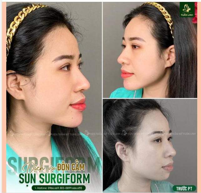 Cằm đã từng tiêm filler nhưng thiếu độ nhô, độ trượt khiến gương mặt thiếu cân đối.