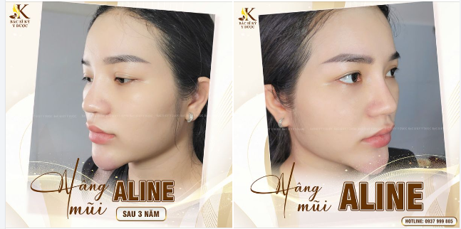 NÂNG MŨI ALINE - SAU 3 NĂM VẪN ĐẸP XUẤT SẮC
