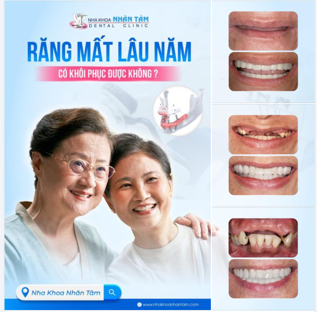 Răng mất lâu năm có khôi phục được không?