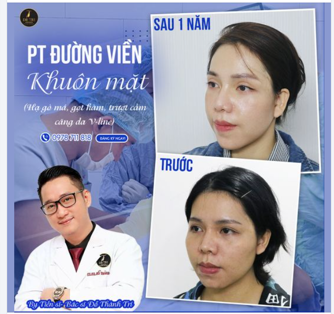 PHẪU THUẬT ĐƯỜNG VIỀN KHUÔN MẶT